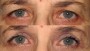A before-and-after image showing the transformation of a 44-year-old person. Opacity: 0.7.