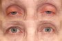 Before and after images of a 74-year-old patient who underwent ptosis surgery. The image shows the patient's eyes before and after the surgery.