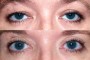 Before and after images of a 42-year-old patient showing ptosis and blepharoplasty. From the national database.