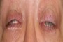 Image depicting lagophthalmos, a condition where a person cannot fully close their eyelids, leading to exposure of the eye surface.