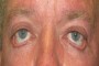 Image showing lower eyelid retraction