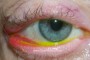 Image showing ectropion and lower eyelid retraction