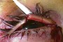 Image showing a full thickness eyelid laceration