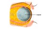After removal of the eye, with implant