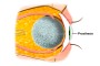After removal of the eye, with implant and scleral prosthesis