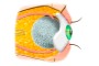 After removal of the eye, with implant and fitted prosthesis
