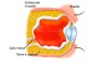 Image of a shrunken, non-functional eye with a watermark