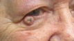 Image showing Keratoacanthoma on the Right Lower eyelid