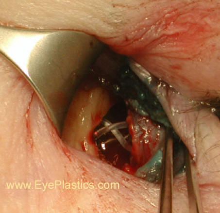 Probe / Intubate