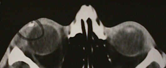CT scan showing eyelid trauma with avulsion