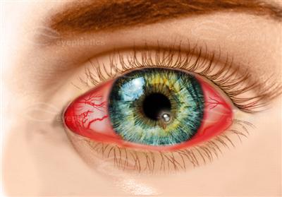Bacterial Corneal Ulcer Red eye