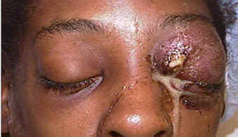 Representation of orbital infection showing affected areas around the eye
