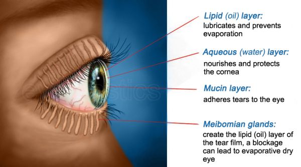Image of Blepharitis showing inflamed eyelid margins with visible redness and swelling.